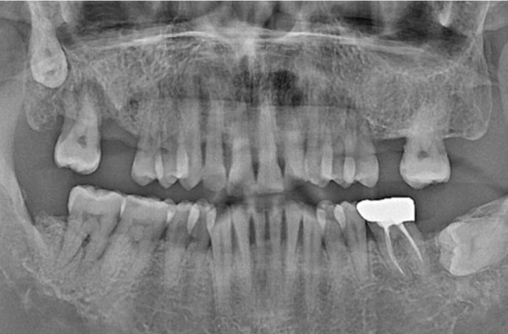 X-Ray